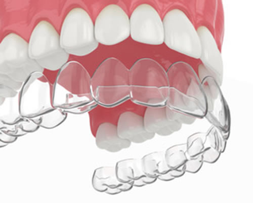 CLEAR ALIGNERS